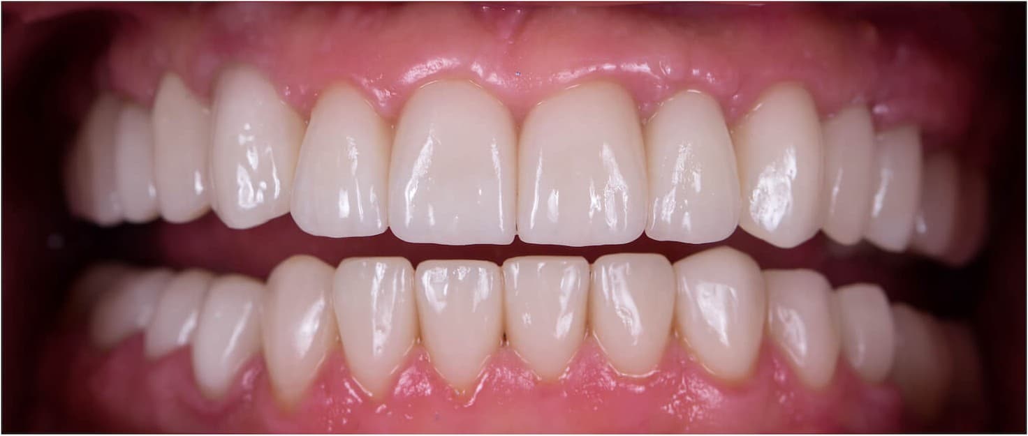 Complete upper arch restoration — after treatment