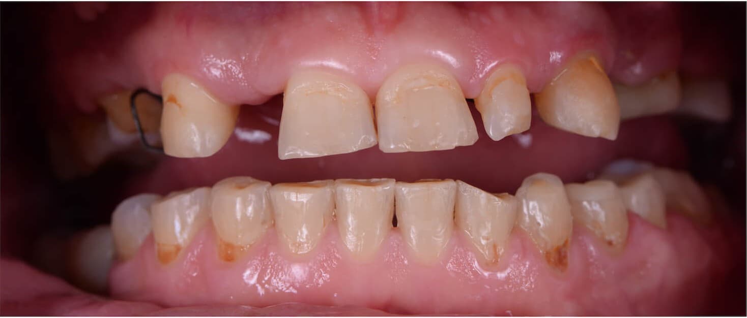 Complete upper arch restoration — before treatment