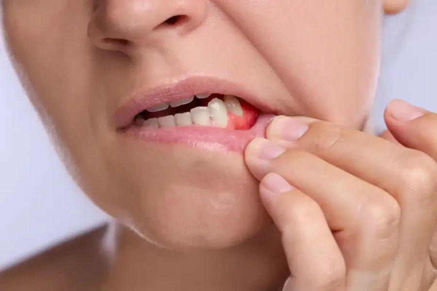 Gum Disease Treatment — Dr. Mukesh Dental, Kothrud Pune