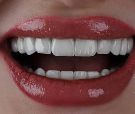 Close-up of a healthy, complete smile after full mouth rehabilitation
