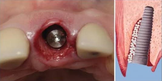 Immediate loading dental implant — clinical placement photo alongside a cross-section diagram showing the implant fused in bone
