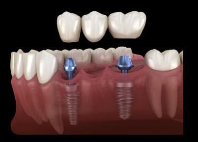 Multiple tooth dental implant diagram — two implants supporting a three-unit fixed bridge