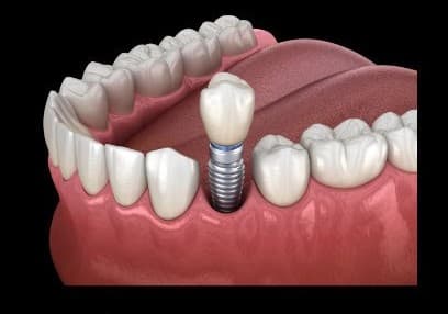Single tooth dental implant diagram — titanium post and crown replacing one missing tooth