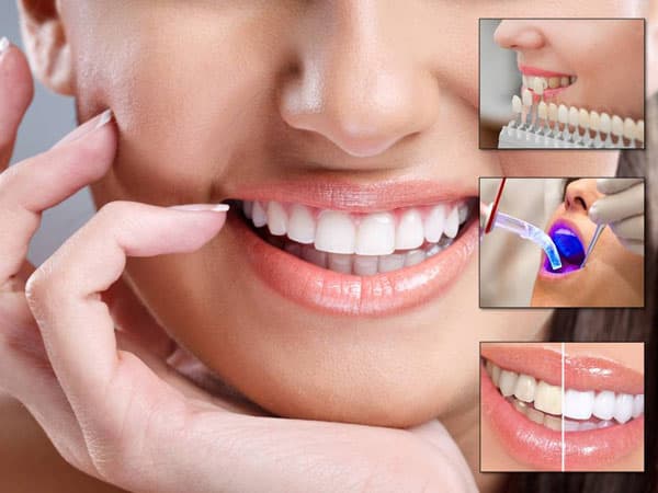 Collage of cosmetic and restorative dental treatments — veneers, whitening, and smile makeover results