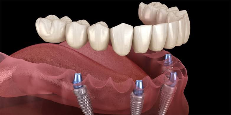 All-on-4 dental implant diagram — four implants supporting a full fixed dental arch